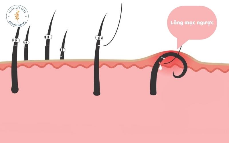 Lông mọc ngược - Tác hại thường gặp của mỡ trăn khi sử dụng không đúng cách